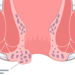 hemorroidas externas