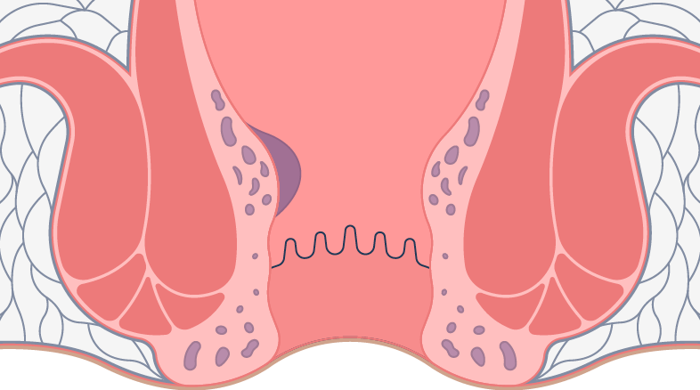 hemorroidas-grau1 hemorroidas grau1