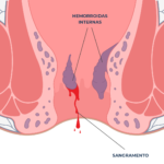 hemorroidas internas